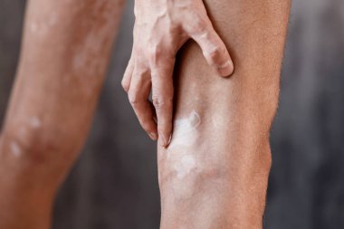 Vitiligo on the feet of the skin, skin care ha