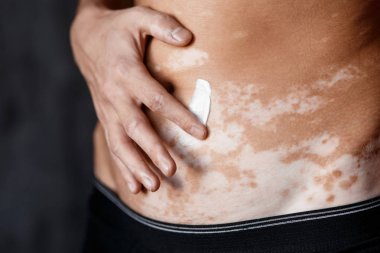Vitiligo on hands and elbows with black background 