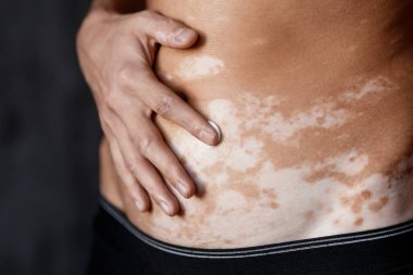 Vitiligo on hands and elbows with black background 