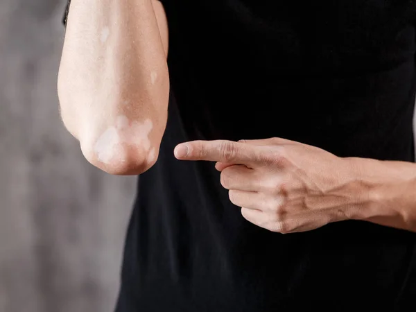 Vitiligo a mãos e cotovelos com fundo preto — Fotografia de Stock