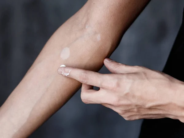 Vitiligo close-up bem mãos em um fundo preto — Fotografia de Stock