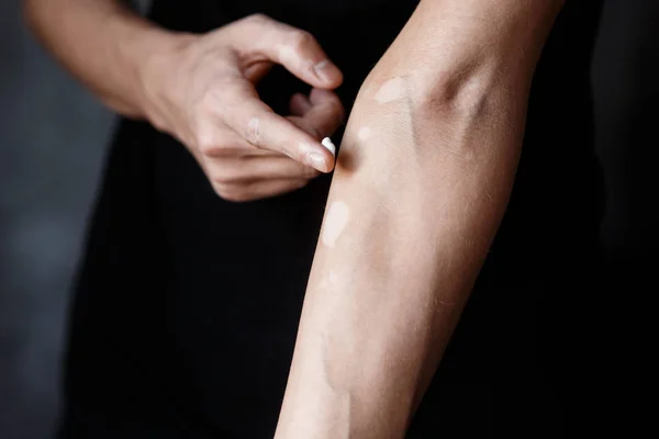 Vitiligo close-up bem mãos em um fundo preto — Fotografia de Stock