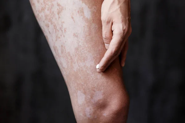 Vitiligo on the feet of the skin, skin care ha — Stock Photo, Image