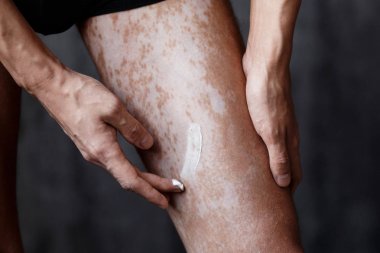 Vitiligo on the feet of the skin, skin care ha