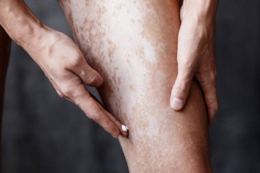 Vitiligo on the feet of the skin, skin care ha