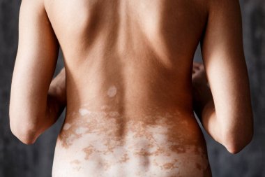 Vitiligo. skin problems in men