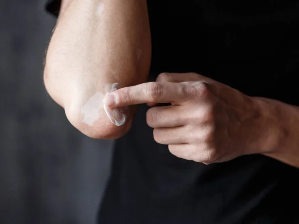 Vitiligo close-up bem mãos em um fundo preto — Fotografia de Stock