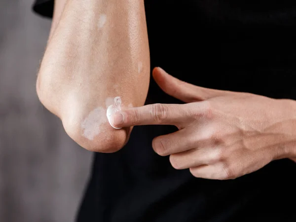 Vitiligo a mãos e cotovelos com fundo preto — Fotografia de Stock