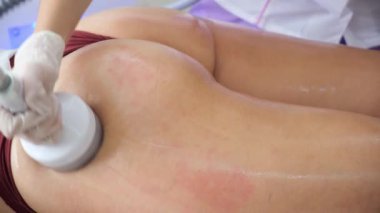 Vücut tedavisi: kadının kalçasına rf kaldırma prosedürü uygulanıyor. Anti-selülit tedavisinde mükemmel kalçalar