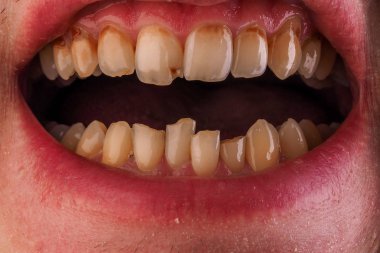 Diş Hekimliği ve sağlık - insan hasta çürük diş çürümesi gösterilen ağız açın. Sağlıksız takma diş, tartar ön dişler, plak ve dişeti iltihabı.