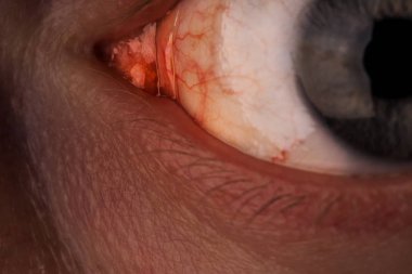 Bir adamın kırmızı göz.