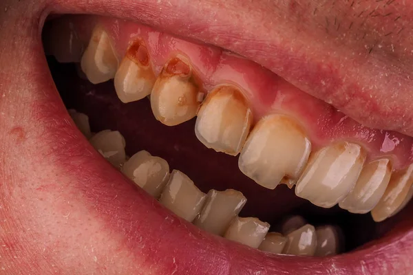 Zubní Lékařství Zdravotnictví Lidské Pacient Otevřít Ústa Ukazující Kazy Zubů — Stock fotografie