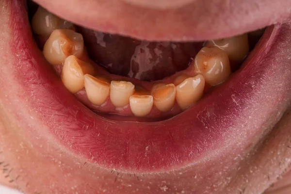 Maloclusão Agrupamento Dos Dentes Mandíbula Inferior Close Homem Boca Com — Fotografia de Stock