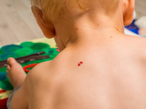 Angioma on the skin back little boy. Red moles on the body. Many birthmarks.