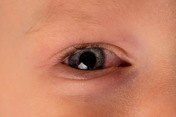 アレルギー性結膜炎の子供彼の目 病気の少年 イライラや感染した赤い血走った目 化膿性細菌性結膜炎のクローズ アップ — ストック写真