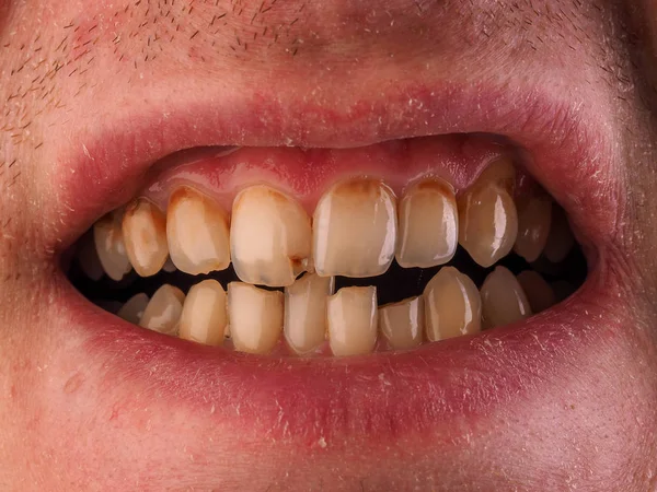 Medicina Dentária Cuidados Saúde Boca Aberta Paciente Humano Mostrando Cárie — Fotografia de Stock