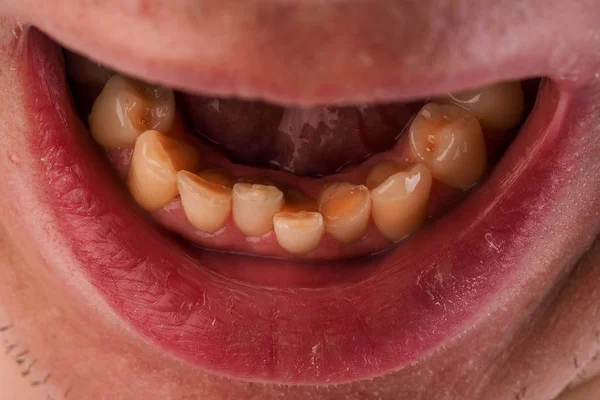 Maloclusão Agrupamento Dos Dentes Mandíbula Inferior Close Homem Boca Com — Fotografia de Stock