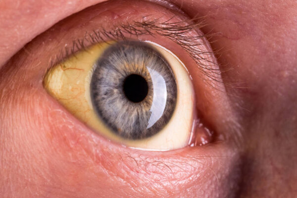 Обструктивная желтуха с тяжелым желтоватым изменением цвета глаз
. 