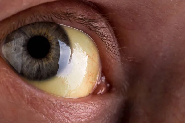 Obstruktive Gelbsucht Mit Schweren Gelblichen Verfärbungen Der Augen — Stockfoto