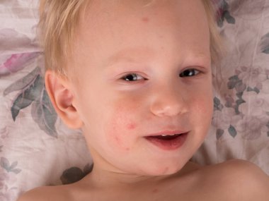 Kuru cilt hasta bir çocuğun. Çocuk ve sağlık. Kuru cilt bebek hasta. su çiçeği. çocukluk hastalıkları ve tedavisi, alerji bebeklerin. Tıp ve ilaç