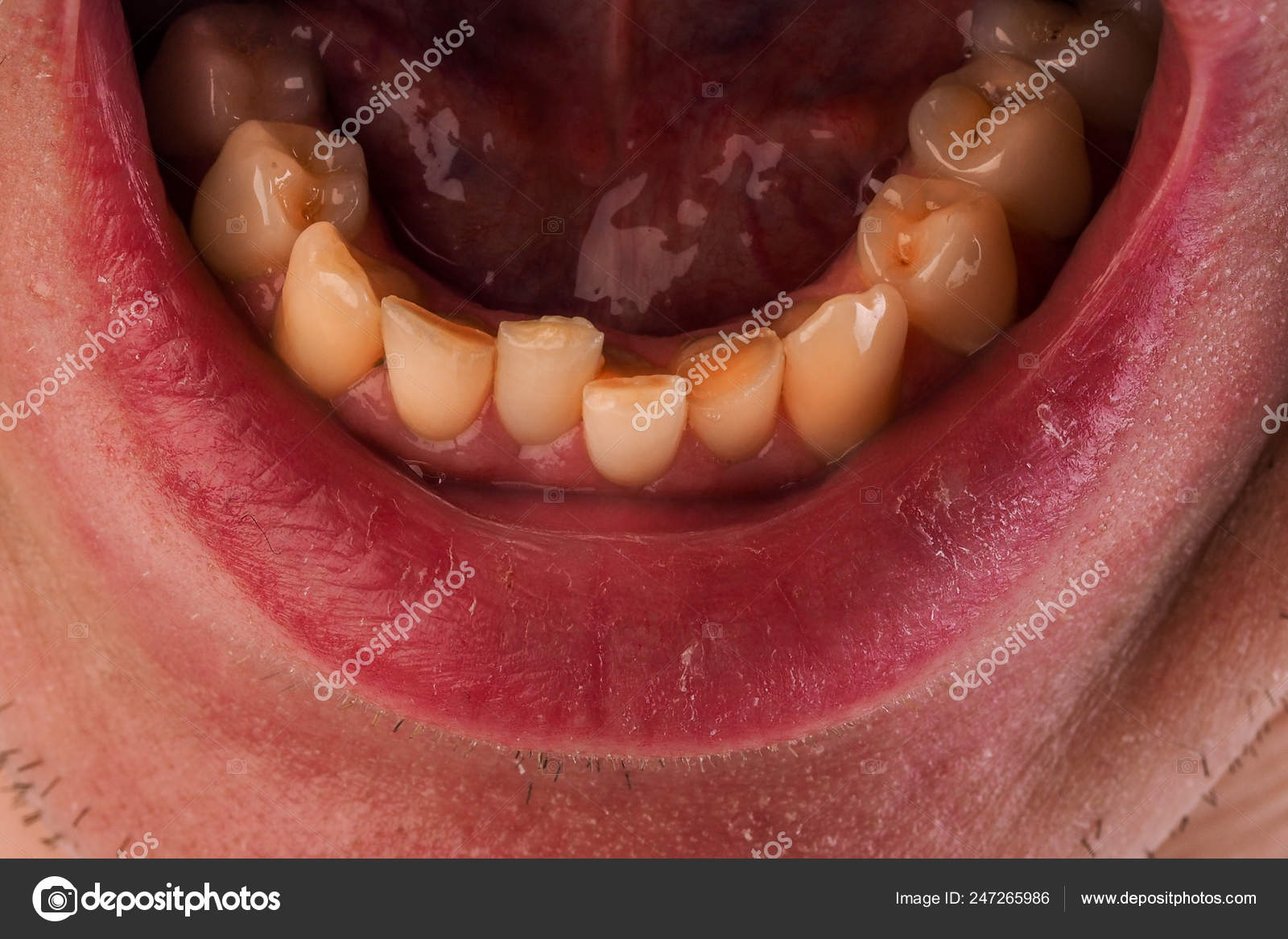 Crooked Bottom Teeth