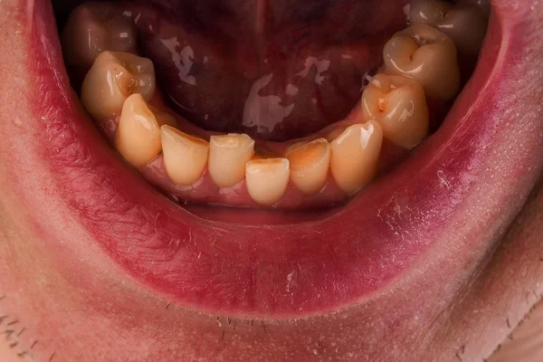 Wady Zgryzu Stłoczenie Zębów Żuchwy Zbliżenie Usta Człowieka Krzywymi Zębami — Zdjęcie stockowe