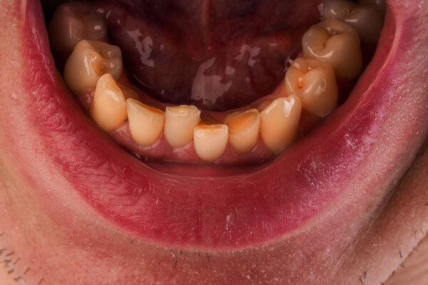 Malocclusion. Crowding of the teeth of the lower jaw. Close-up of a man mouth with crooked teeth.