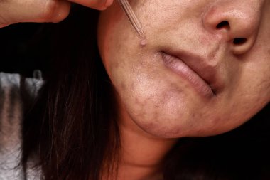 Akne cilt sorunu fotoğraf kadar yakın, Asyalı kadın anti-a uygulayarak