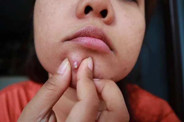 Woman squeezing pimple with dirty bare hands, Removing pustules
