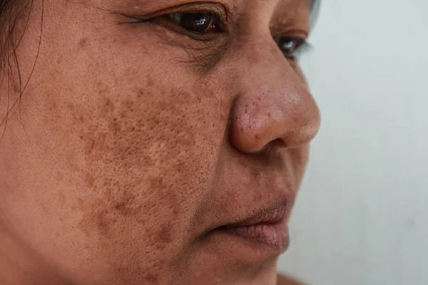 Problema de la piel, primer plano piel cara asiático mujeres con punto melasma . — Foto de Stock