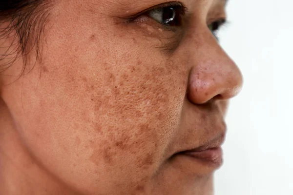 Problem skóry, zbliżenie skóry twarzy azjatyckich kobiet z Spot melasma. — Zdjęcie stockowe