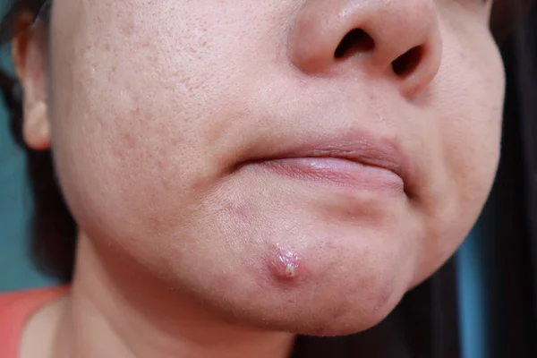 Woman squeezing pimple with dirty bare hands, Removing pustules — Stock Photo, Image