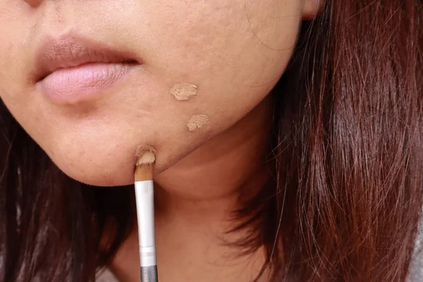 Akne hudproblem, närbild av asiatisk kvinna ansöker concealer göra — Stockfoto
