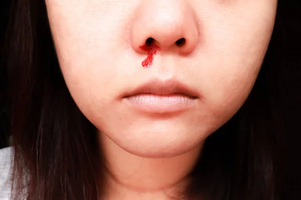 Mujer asiática joven está sangrando por la nariz, hemorragia nasal, sangre n — Foto de Stock