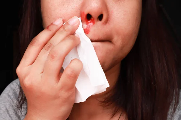 Young asian woman is bleeding from her nose, using tissue paper