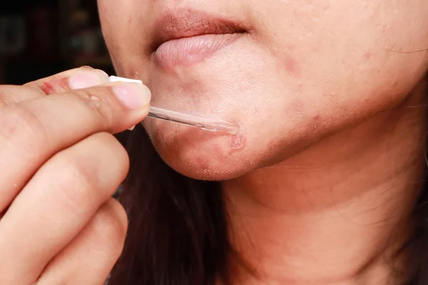 Close up photo of acne skin problem, Asian woman applying anti-a — Stock Photo, Image