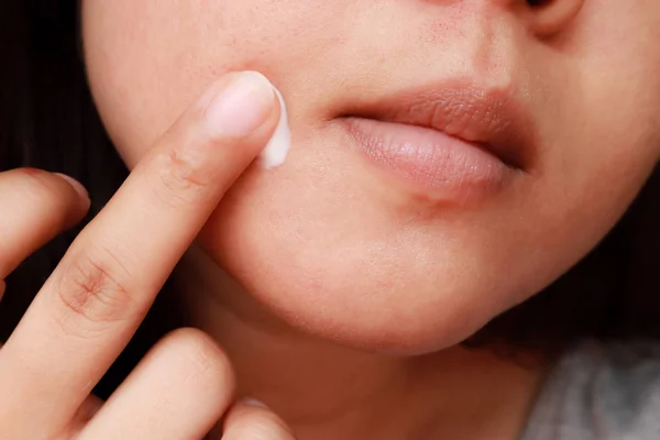 Close up photo of acne skin problem, Asian woman applying anti-a — Stock Photo, Image