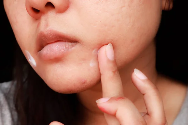 Close up photo of acne skin problem, Asian woman applying anti-a — Stock Photo, Image