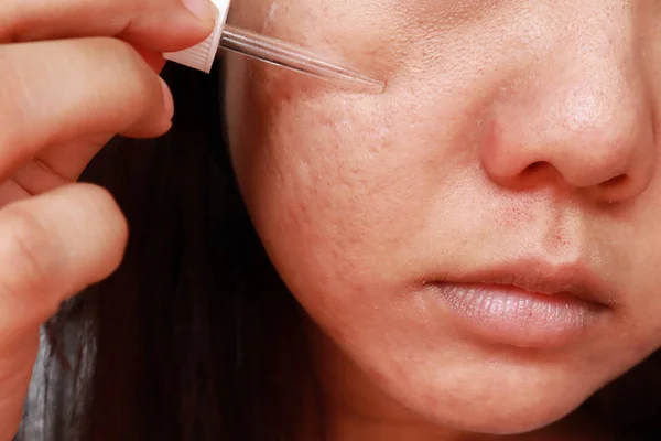 Close up photo of acne skin problem, Asian woman applying anti-a — Stock Photo, Image