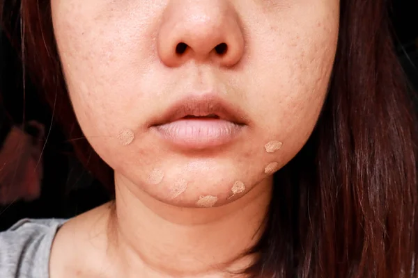 Akne Hautproblem, Nahaufnahme von asiatischen Frau Anwendung Concealer Make — Stockfoto