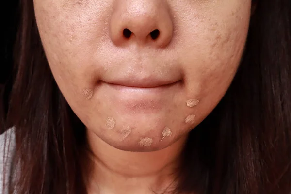 Acne problema de pele, Closeup de mulher asiática aplicando corretor fazer — Fotografia de Stock