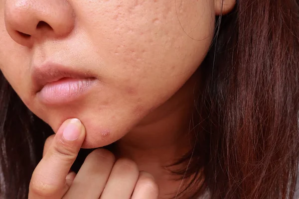 Pustulas whitehead acne do rosto, problemas com acne e cicatriz o — Fotografia de Stock