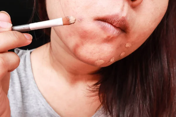Acercamiento de la mujer asiática que aplica maquillaje corrector para ocultar el acné fa —  Fotos de Stock