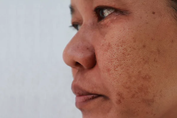 Hudproblem, närbild hud ansikte asiatiska kvinnor med spot melasma, Stockbild