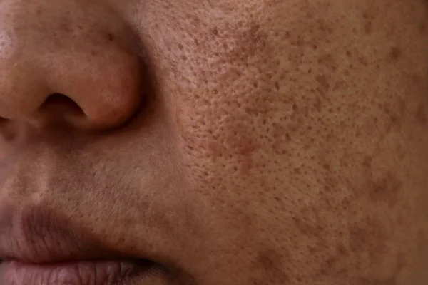Problema di pelle, primo piano pelle faccia asiatico donne con spot melasma . Immagini Stock Royalty Free