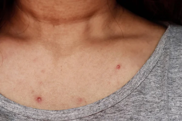 Skin problem,  acne, red spots. Asian women scratching her shoul Stock Photo