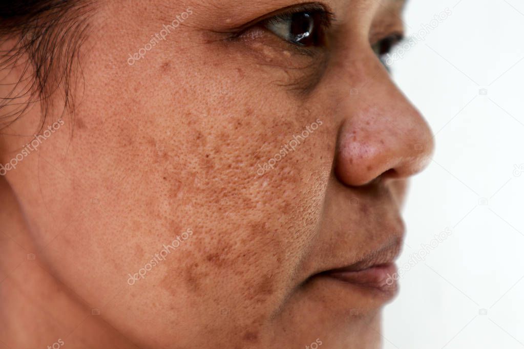 Skin problem, Closeup skin face asian women with spot melasma.