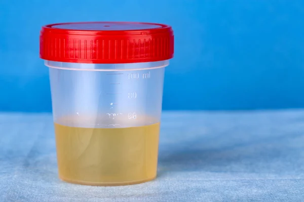 Contenitore di plastica con analisi delle urine — Foto Stock