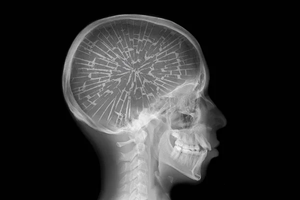 Rayos Cráneo Con Cerebro Roto —  Fotos de Stock