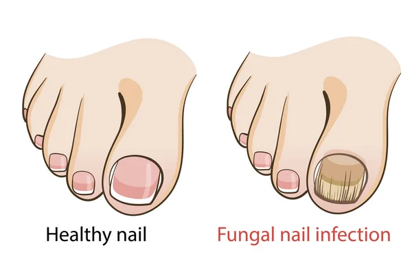 Nail Fungal Infection Medical Poster — Stock Vector
